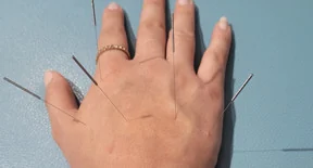 Dorso de uma mão com agulhas de acupuntura aplicadas em pontos selecionados.